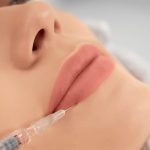 augmento-labios-acido-hialuronico-be-fabulous-madrid-centro-medico-estetico