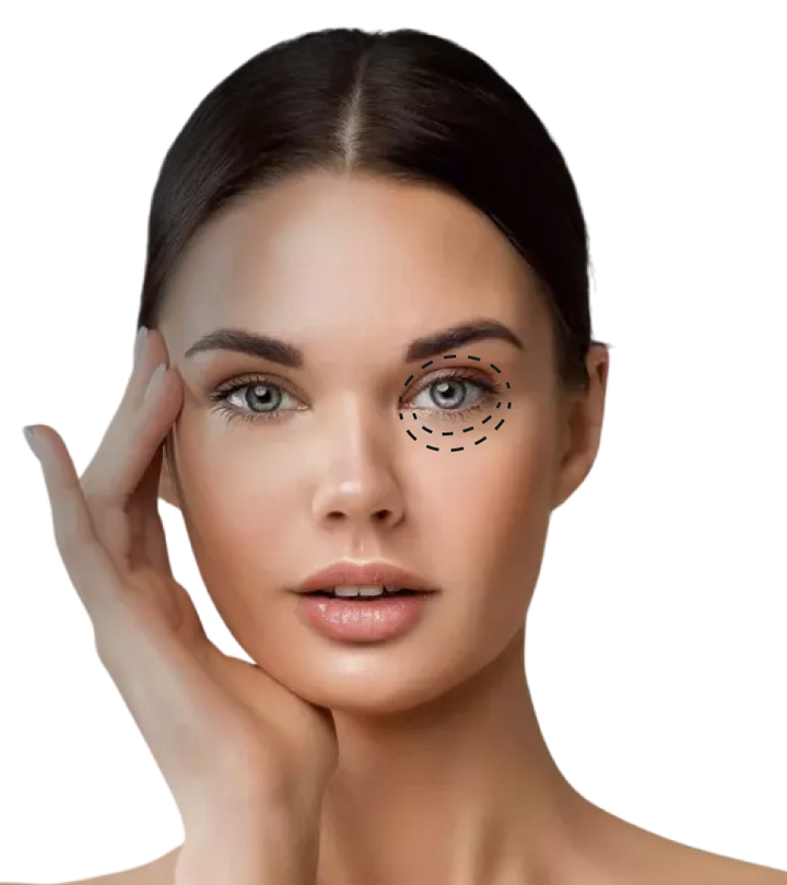 blefaroplastia4
