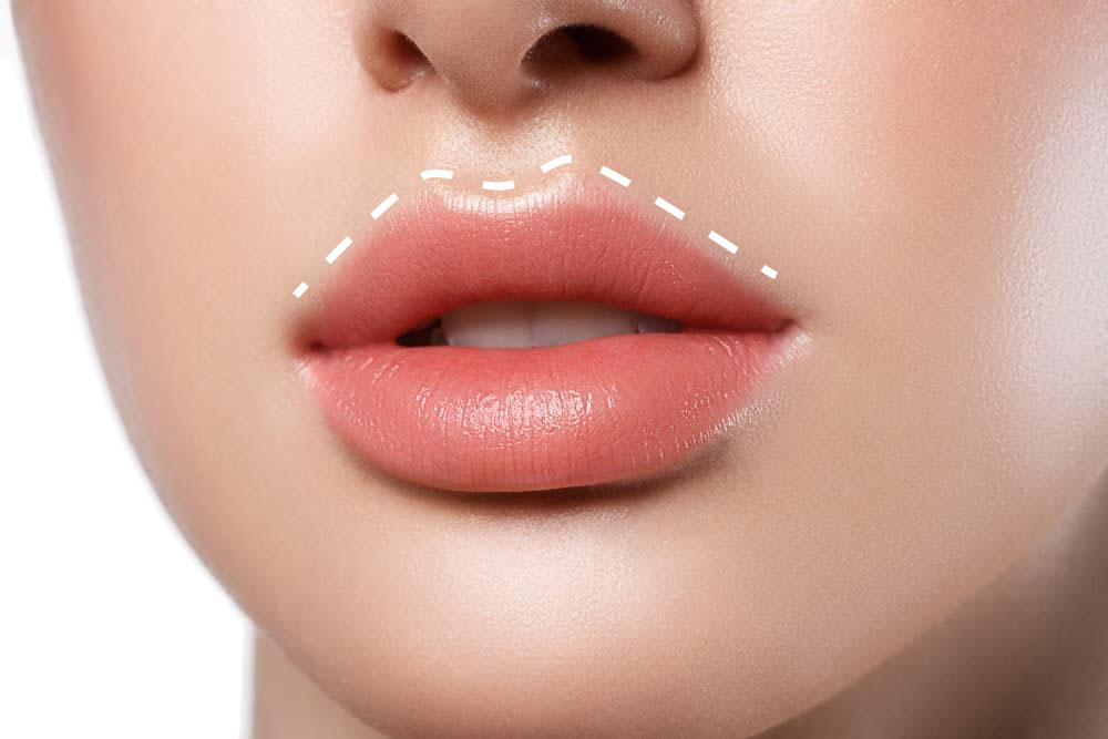 liplift-aumento-labios-cirugia-madrid
